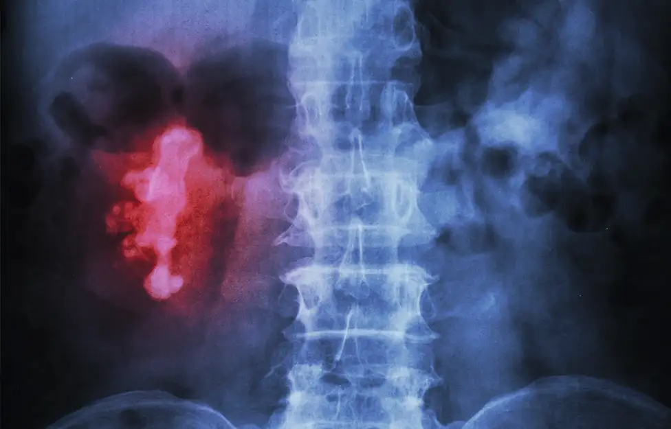 Lithiasis Clinic2.jpg